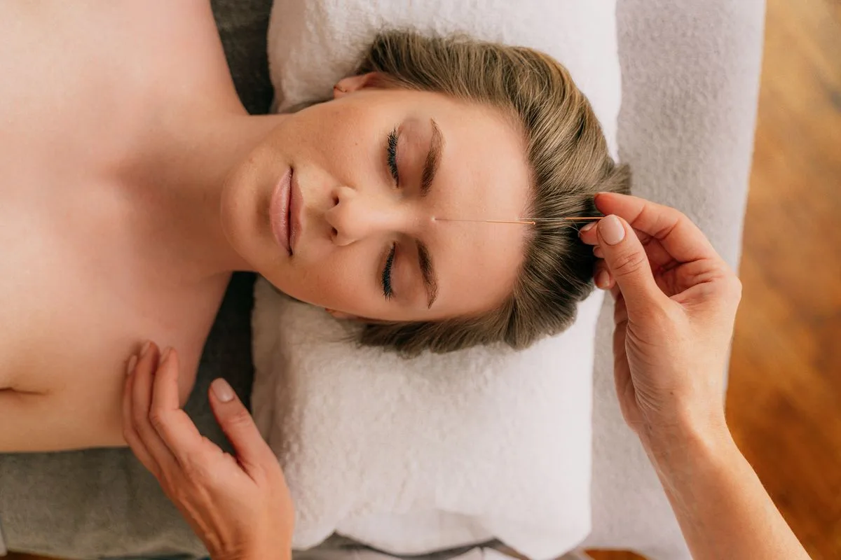 A woman lying calmly with her eyes closed while an acupuncturist places a fine needle near her temple
