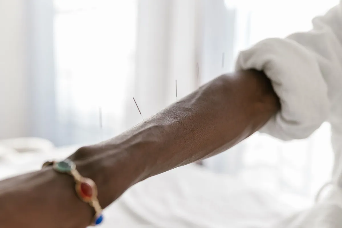 Fine acupuncture needles in a person's forearm, with a colorful bracelet on the wrist